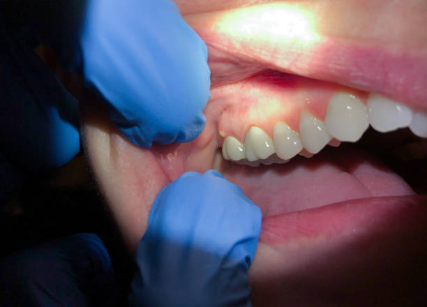 Best Emergency Tooth Extraction in Annandale, VA