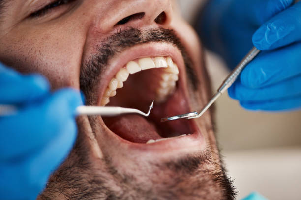 Best Emergency Tooth Extraction in Annandale, VA