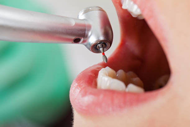 Best Emergency Root Canal Treatment in Annandale, VA